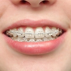 大人の矯正歯科について